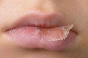 bibir kering